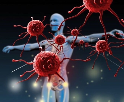 Phẫu thuật nội soi thu nhỏ dạ dày có giảm nguy cơ mắc ung thư không?